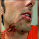 A man who authorities say was assaulted in Baltimore Aug. 21, 2014, shows injuries he suffered in the attack that he believes was a hate crime.
CBS Baltimore Screenshot